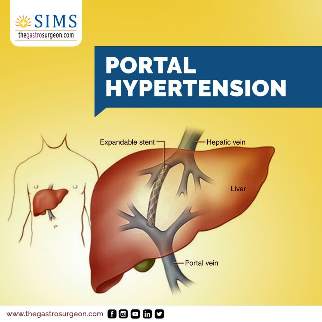 1compressed DrPATTAS Portal Hypertension treatment in Chennai at Dr Patta's Gastro Center