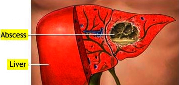 Abscessliver DrPATTAS Liver Abscess Symptoms Causes and Treatment