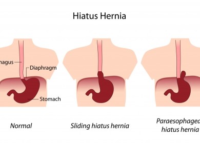 HiatalHerniainThreeParts390x2791 DrPATTAS Best Hiatus Hernia diagnosis in Chennai