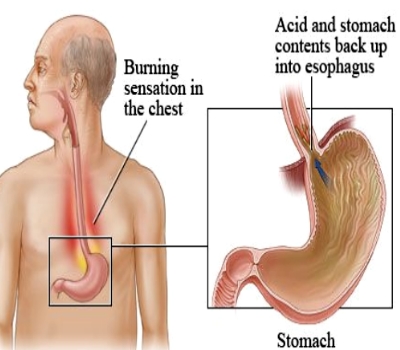 acidinjurytosrmch DrPATTAS Corrosive Stomach Injury Treatment at Dr Patta's Gastro Center