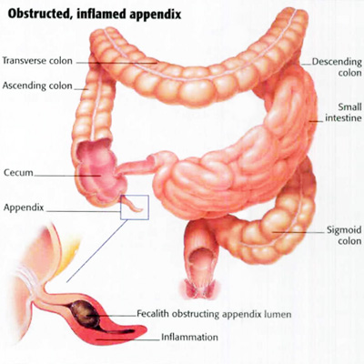 Appendicitis Symptoms and Treatment in Chennai