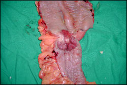 Colorectal Surgery