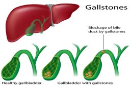 Don’t Let Gallstones Disturb You Again