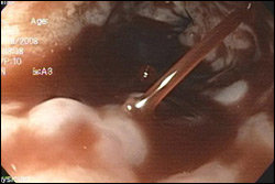 gibleedingsurgery1 DrPATTAS GI Bleeding