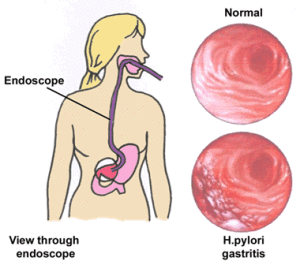 gibleed300x2651 DrPATTAS GI Bleeding surgery at Patta's Gastro centre in Chennai