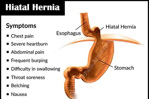 What you should know about Hiatal Hernia Surgery!