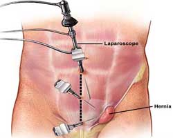 hernia DrPATTAS Daycare hernia repair surgery in Chennai