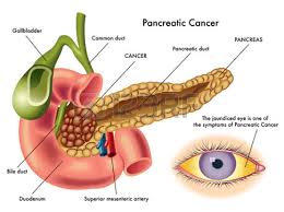 Advanced treatment for pancreatic cancer at Dr Patta's Gastro Centre in Chennai