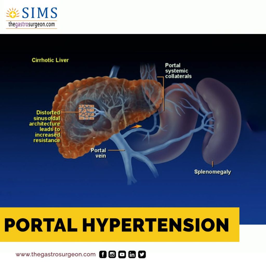 portcompressed DrPATTAS Portal Hypertension treatment in Chennai at Dr Patta's Gastro Center