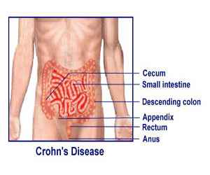 regional DrPATTAS Best Regional enteritis treatment in Chennai