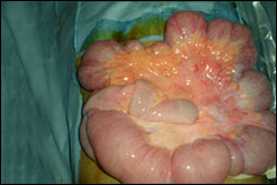 smallbowelsurgery DrPATTAS Small Bowel Surgery