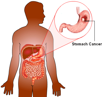 stomachcancer2 DrPATTAS Stomach Cancer Symptoms and Treatment Dr Patta