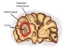Tumor diagnosis  treatment at DrPatta's Gastro centre