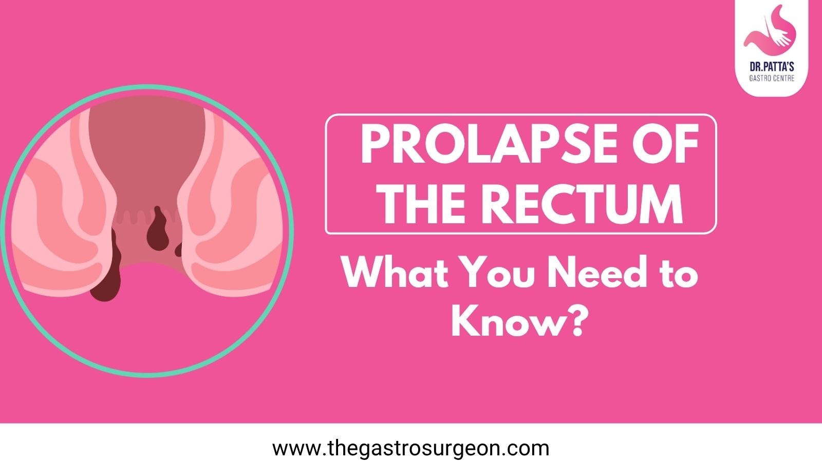 Prolapse of the Rectum: What You Need to Know?